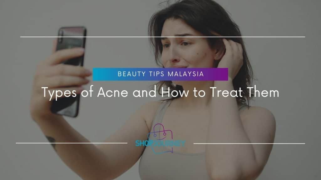 Types of Acne and How to Treat Them - Shop Journey Malaysia