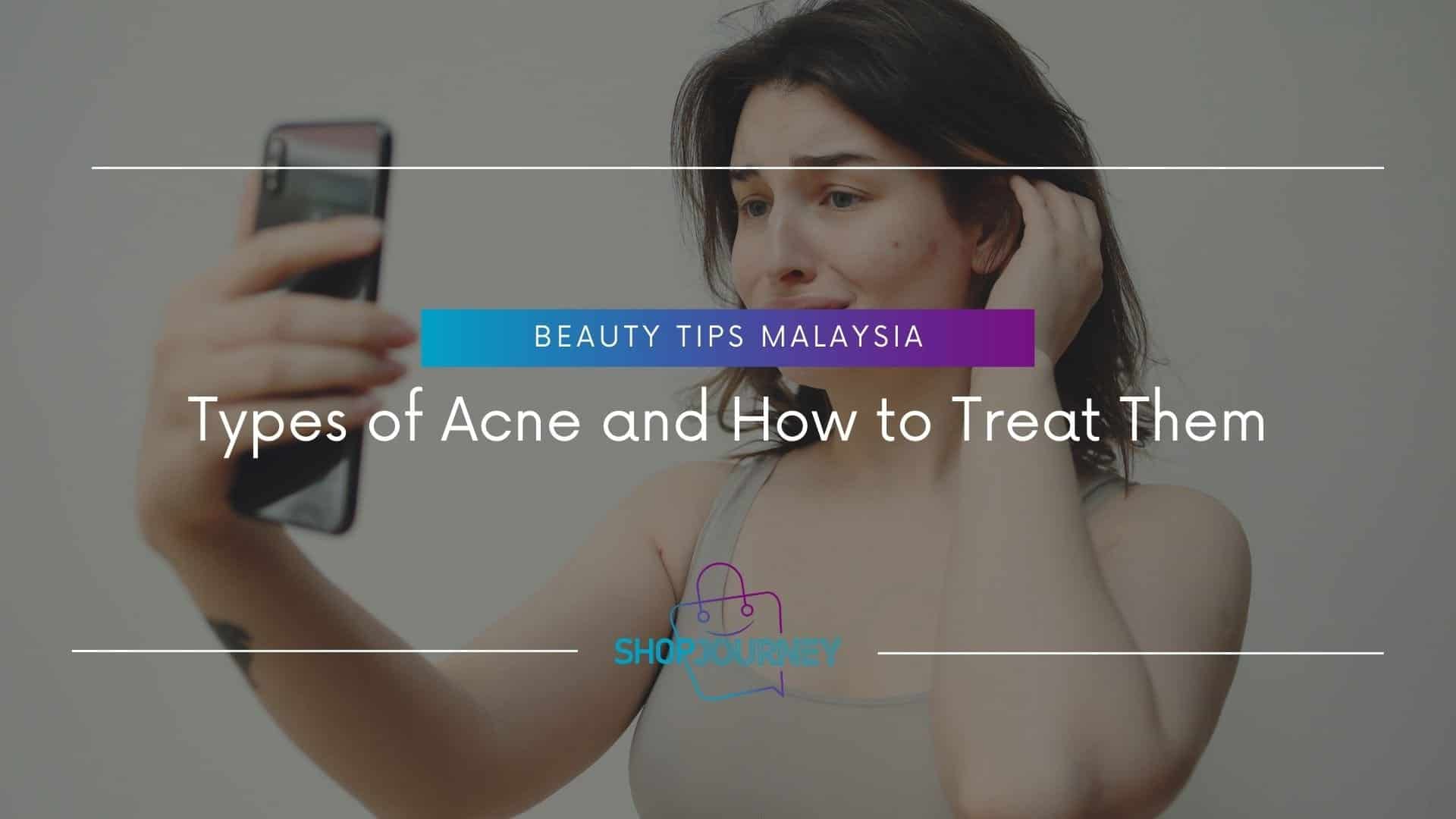 Types of Acne and How to Treat Them - Shop Journey Malaysia